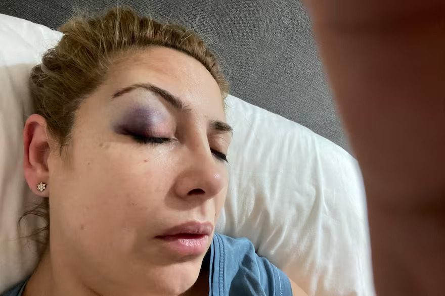  Novas fotos mostram ex-mulher de Alberto Fernández com hematomas no rosto